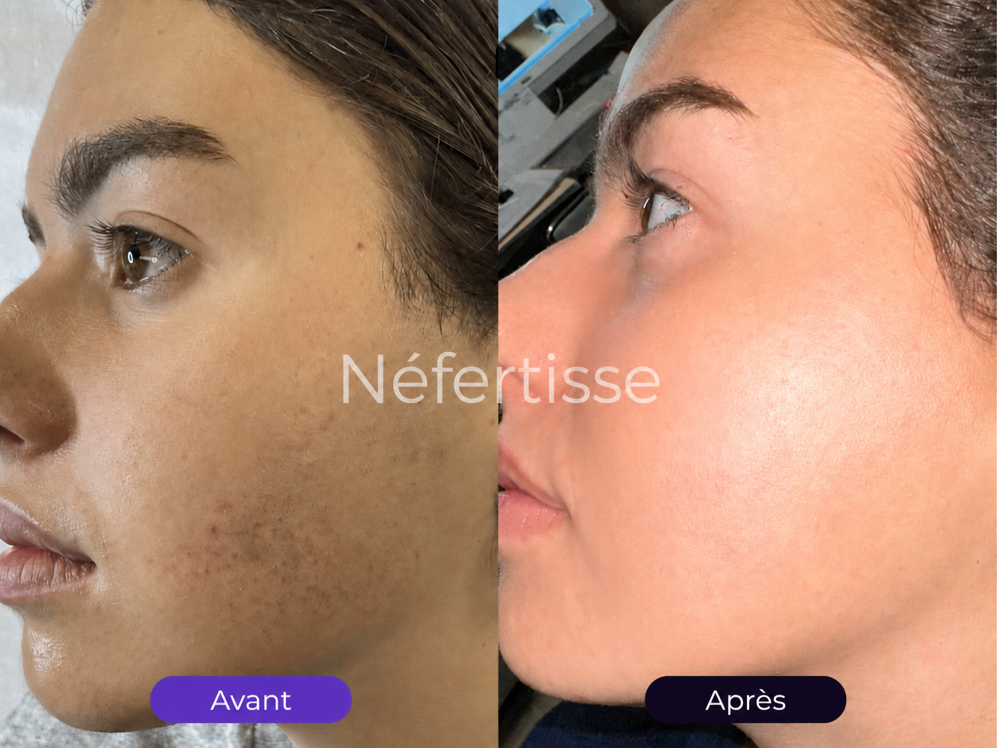 Résultat visage avant après Néfertisse