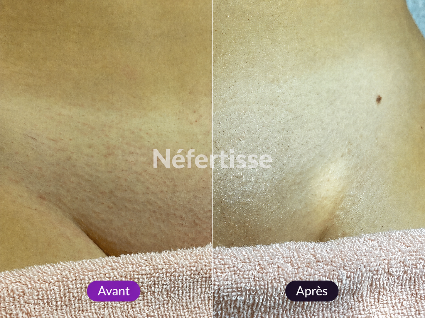 Résultat aine avant après Néfertisse